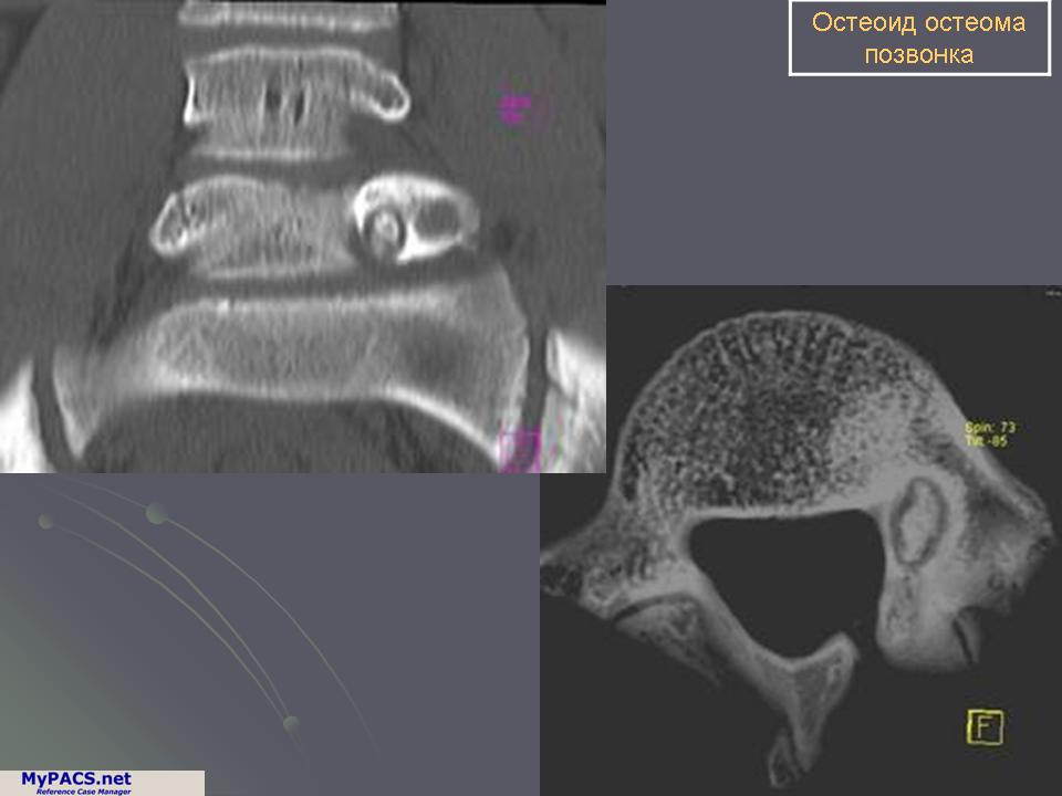 Остеома позвонка. Остеоид остеома на кт позвоночника.