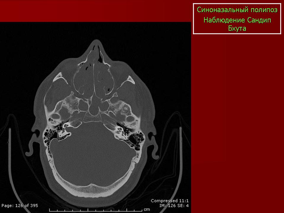 Мукоцеле синуса. Мукоцеле носового синуса кт. Мукоцеле основной пазухи на кт.