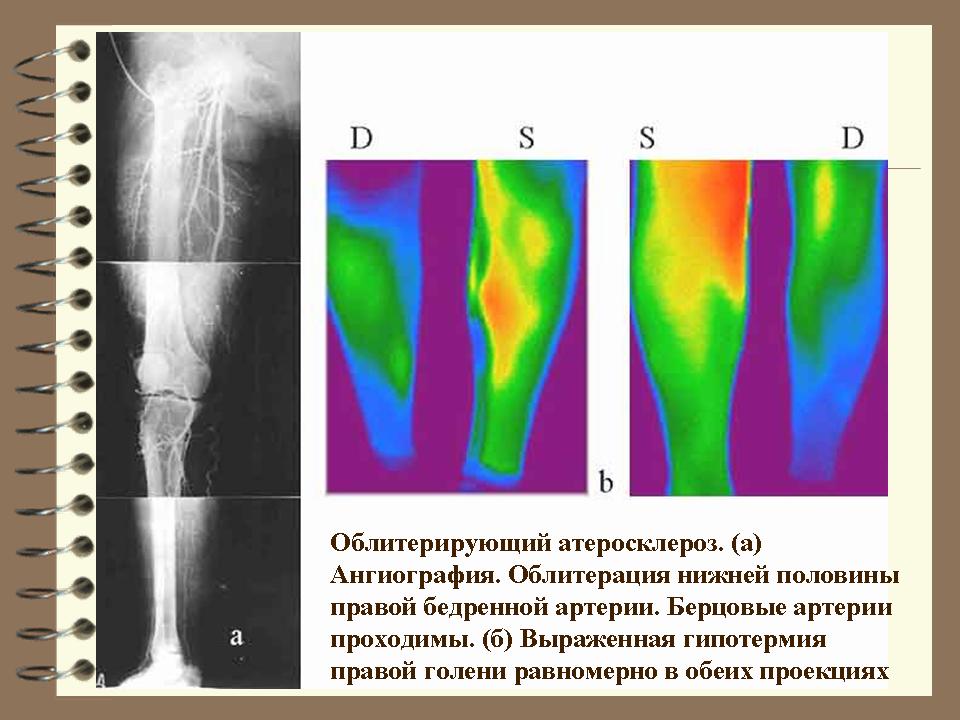 Нижняя половина. Термография нижних конечностей при атеросклерозе. Облитерация просвета артерий. Облитерация бедренной артерии.