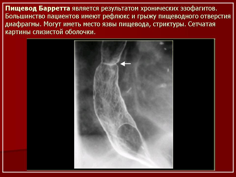 Пищевод б. Пищевод Барретта рентген. Рефлюкс эзофагит пищевода рентген. Пищевод Барретта рентгеноскопия.
