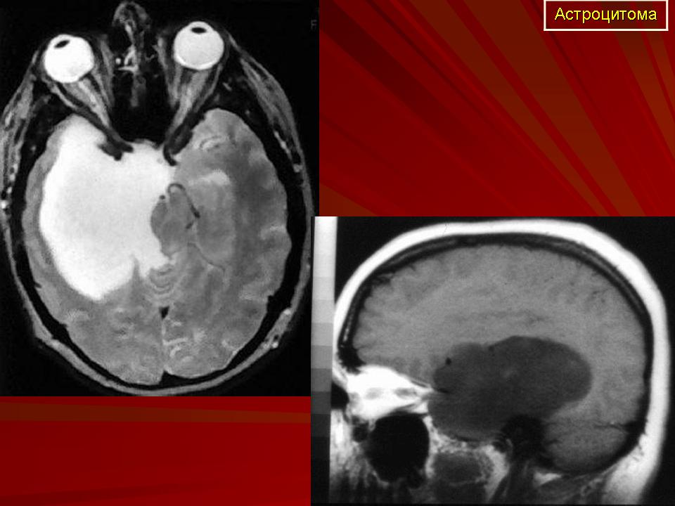 Астроцитома грейд. Мозжечковая астроцитома. Фибриллярная астроцитома кт. Анапластическая астроцитома.