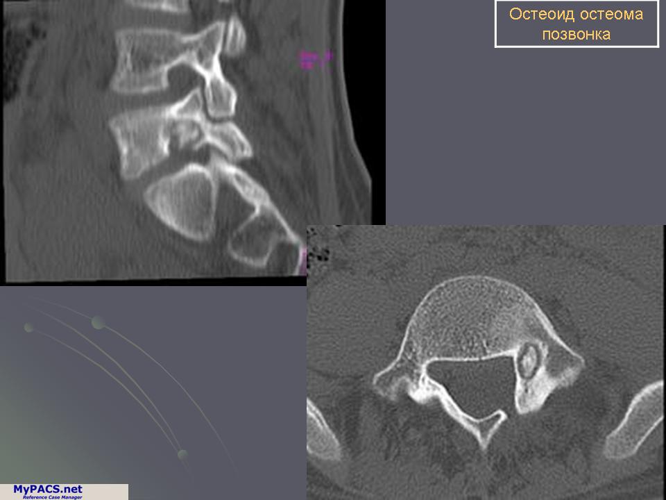 Остеома позвонка. Остеома тела позвонка на кт. Компактная остеома кости кт. Компактная остеома черепа мрт.