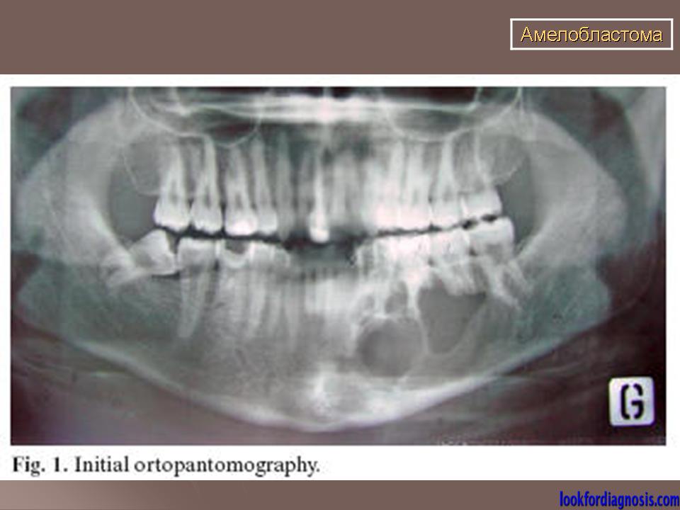 Клиническая картина амелобластомы
