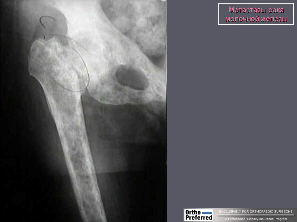 Метастатическое поражение костей. Метастазы в бедренной кости рентген. Метастазы опухоли костей. Дерматофибросаркома метастазирование.