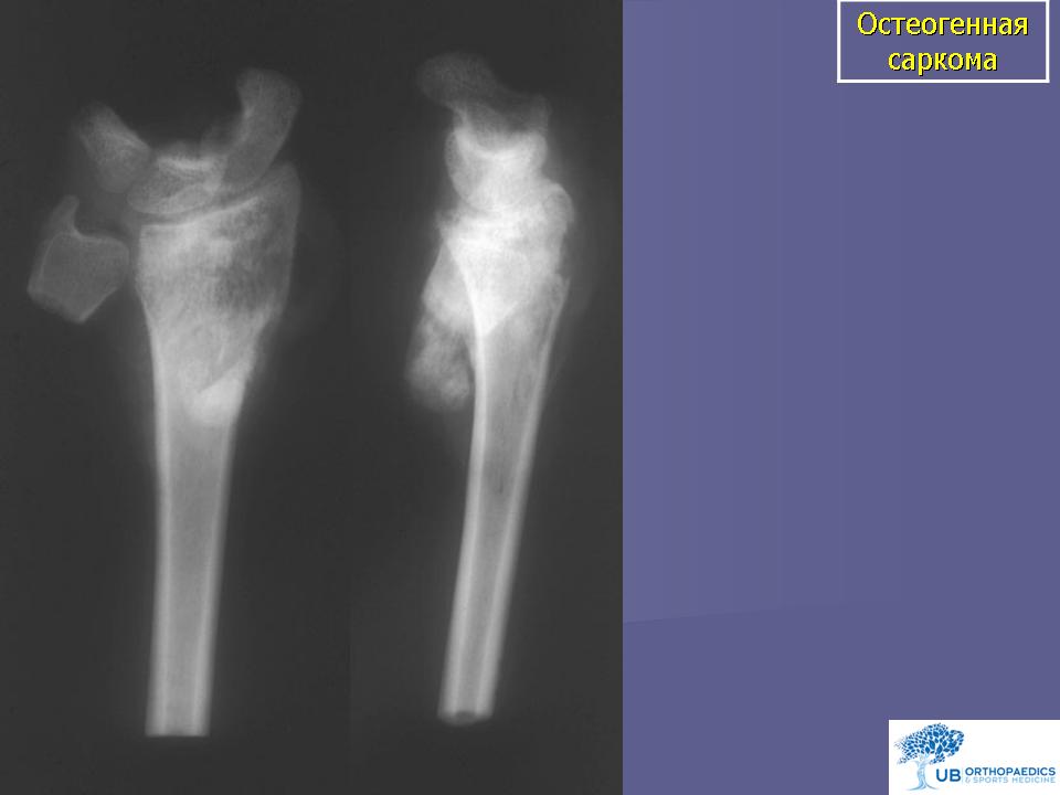 Чем отличается саркома. Остеосаркома коленного сустава. Хондросаркома тазобедренного сустава на рентгене. Остеогенная саркома бедренной кости рентген.