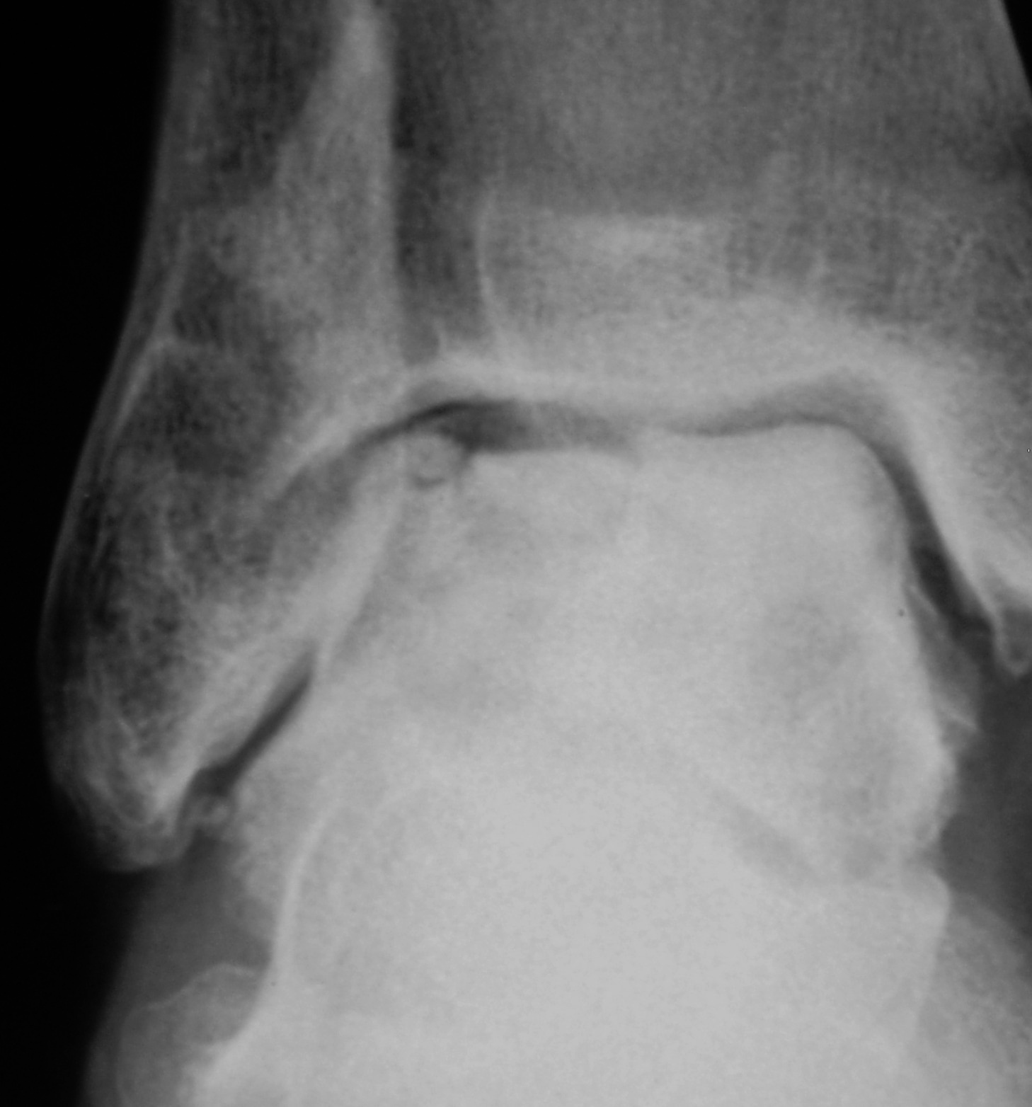 Артроз голеностопного сустава рентген