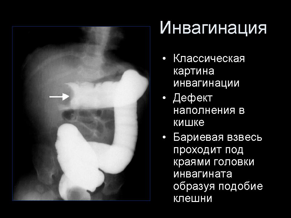 Симптомы непроходимости кишечника