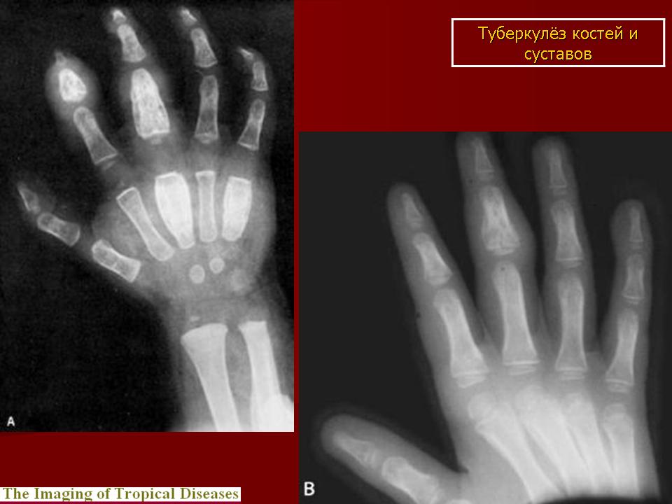 Туберкулез костей. Туберкулез костей рентген кисти. Туберкулез костей запястья. Туберкулез костей и суставов локализация. Туберкулёз кости пальца.
