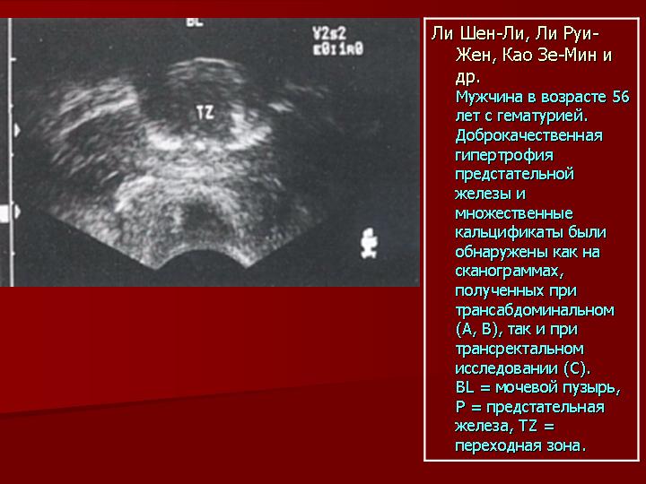 Узи признаки дгпж. Образования предстательной железы на УЗИ. Аденоматозный узел предстательной железы на УЗИ. Узелок предстательной железы.
