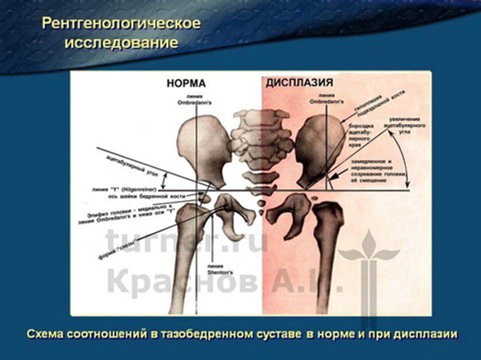 Ацетабулярный угол у детей