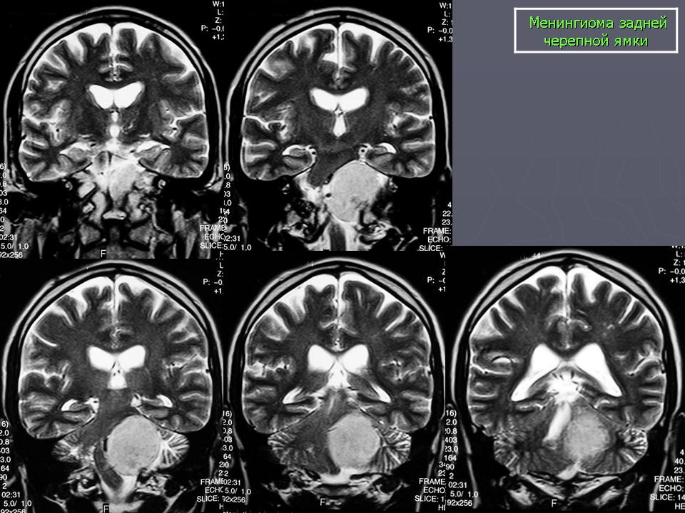 После операции менингиомы головного мозга