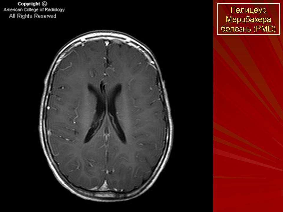 Лейкодистрофия это. Пелицеуса-Мерцбахера. Болезнь Пелицеуса-Мерцбахера мрт. Прогрессирующая лейкодистрофия. Лейкодистрофия мрт.