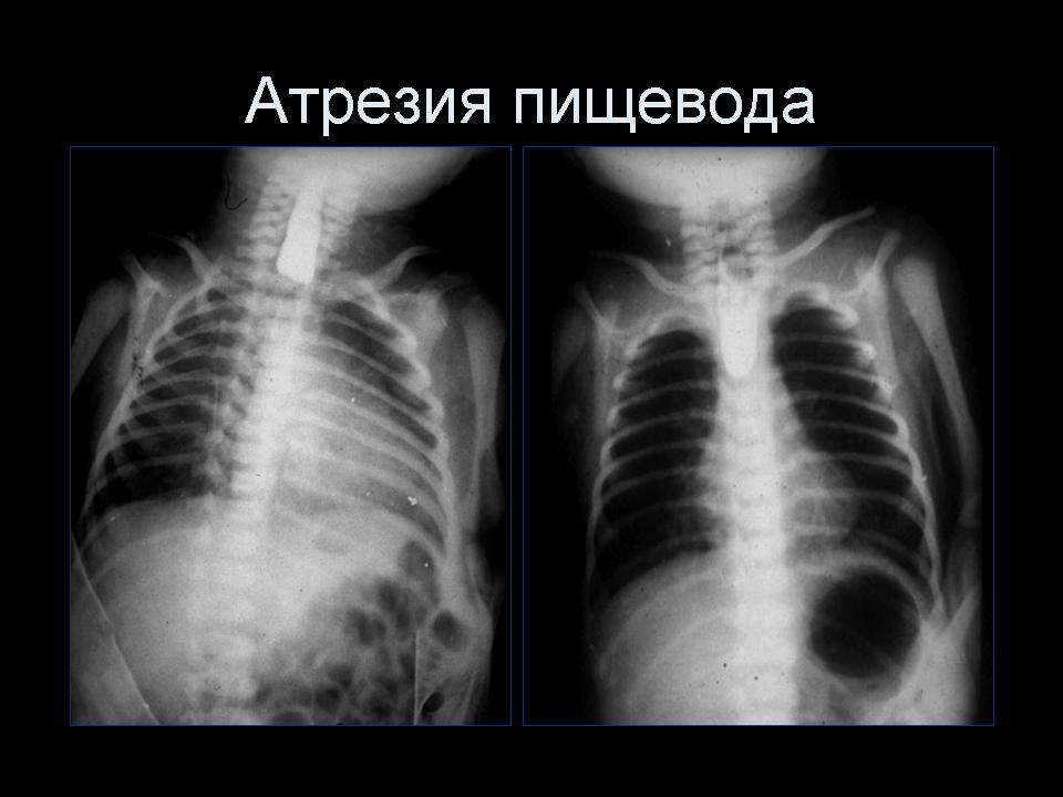 Отсутствие пищевода. Трахеопищеводный свищ рентген. Атрезия пищевода рентген. Атрезия пищевода у детей рентген. Рентген при атрезии пищевода.