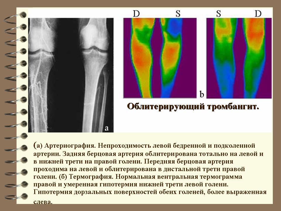 Окклюзия бедренной. Окклюзионных заболеваниях сосудов конечностей. Окклюзия артерий голени. Обструкция артерий нижних конечностей. Окклюзия берцовых артерий.