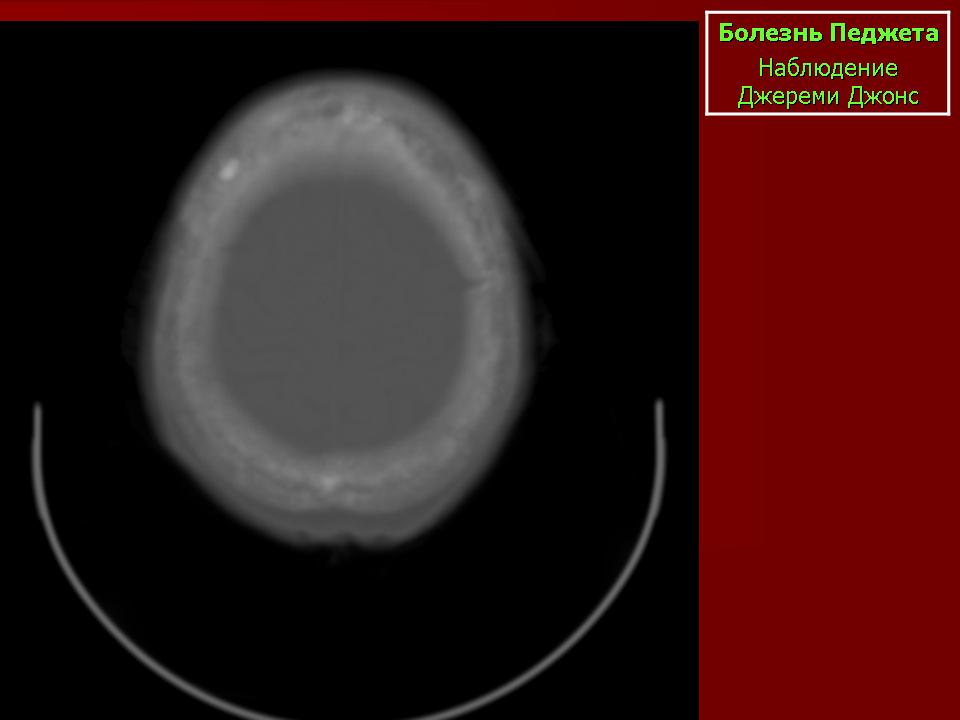 Болезнь педжета. Болезнь Педжета голова кт. Болезнь Педжета молочной железы мрт.
