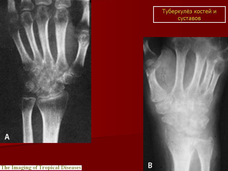 Туберкулез костей фото