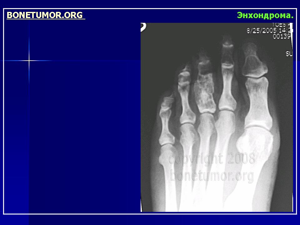 Энхондрома. Хондрома стопы рентген. Энхондрома фаланги стопы кт. Хондрома плюсневой кости.