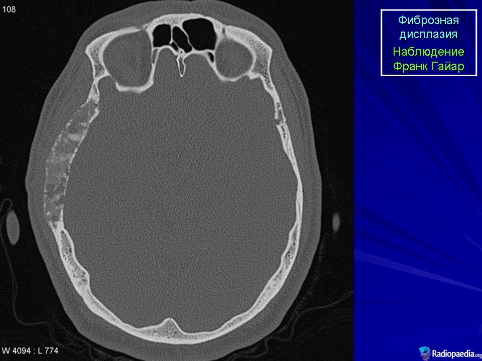 Фиброзная дисплазия. Фиброзная дисплазия теменной кости кт. Эозинофильная гранулема черепа кт. Эозинофильная гранулема костей черепа мрт. Фиброзная дисплазия кости черепа кт.