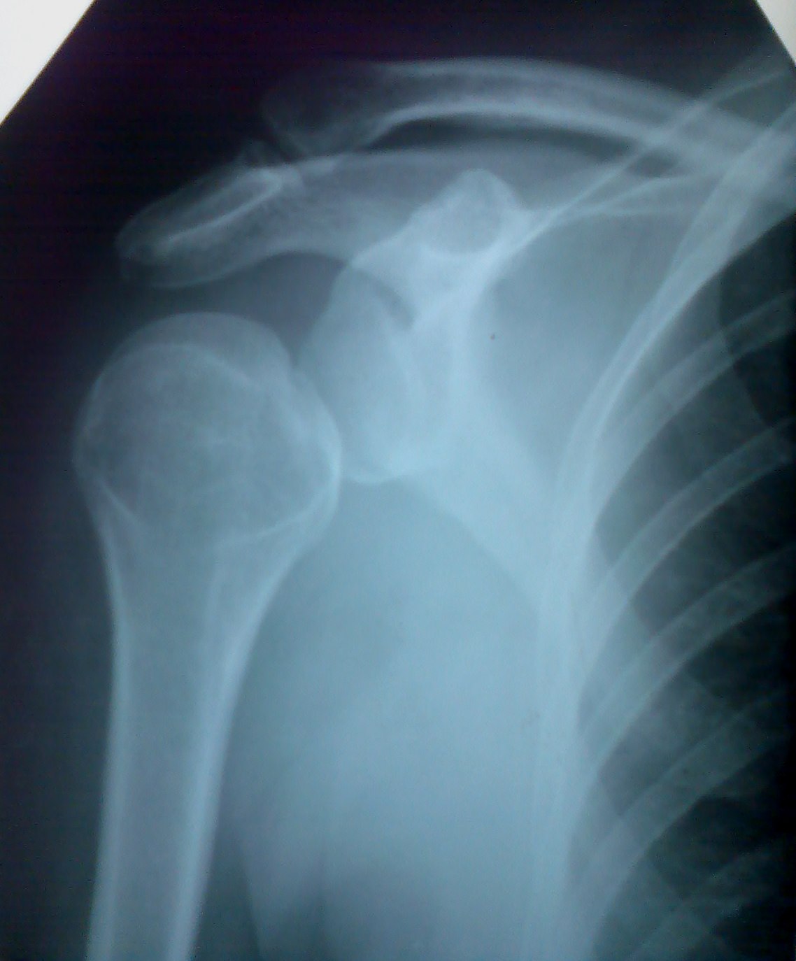 перелом плечевой кости фото