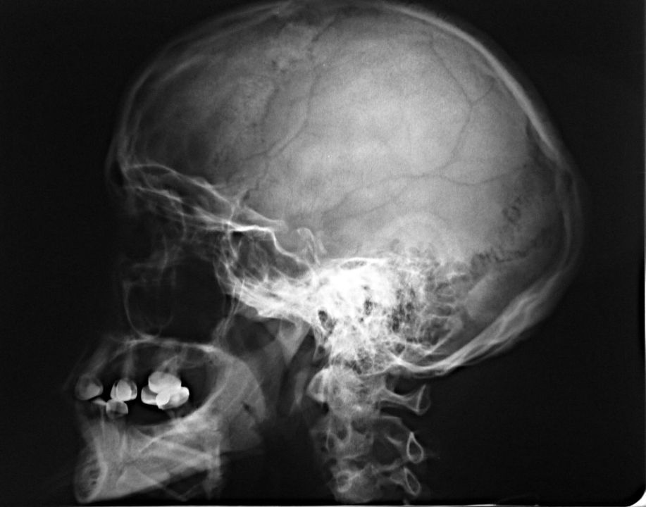 Сотрясение черепа. Опухоль головного мозга рентген черепа. Рентген черепа сотрясение мозга. Опухоли затылочной кости рентген. Рентгеновский снимок головы.