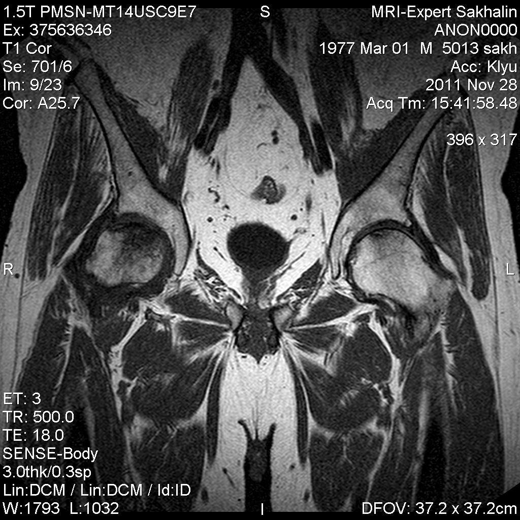 Мрт сочленений. Мрт тазобедренной части. Направление на мрт тазобедренного сустава. Мрт тазобедренного сустава пример.