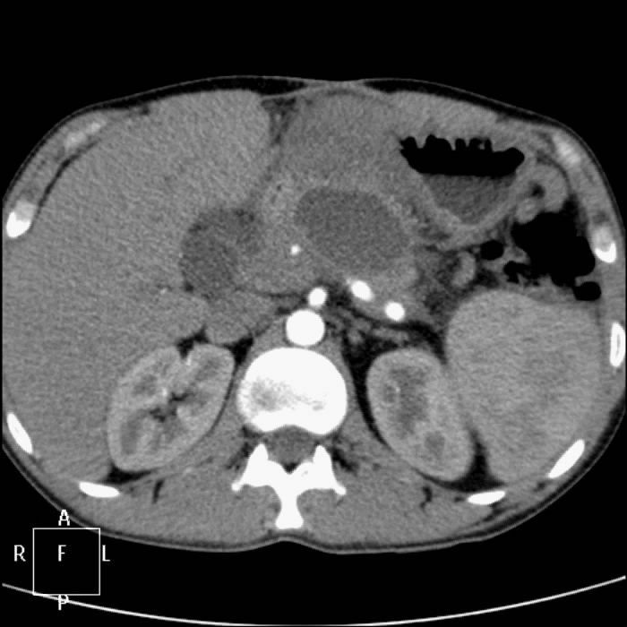Кт картина панкреатита