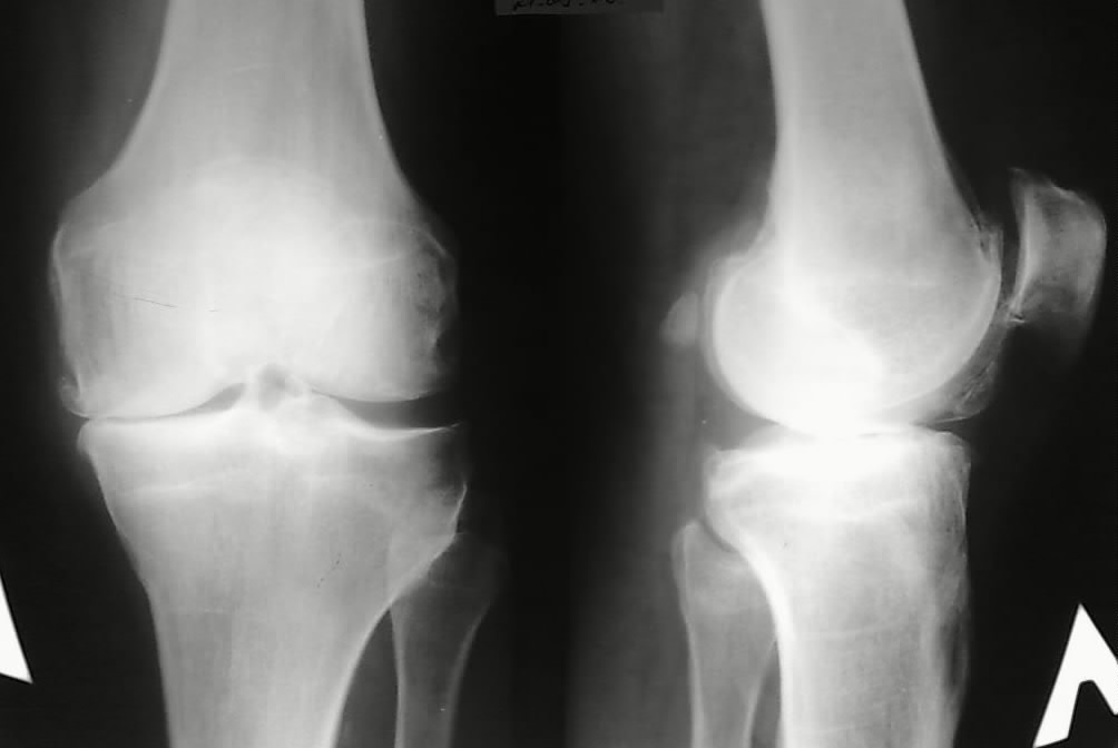 Суставная щель голеностопного сустава. Варусная деформация коленных суставов рентген. Вальгусная деформация коленных суставов рентген. Деформация коленного сустава рентген. Варусная деформация коленных суставов артроз.