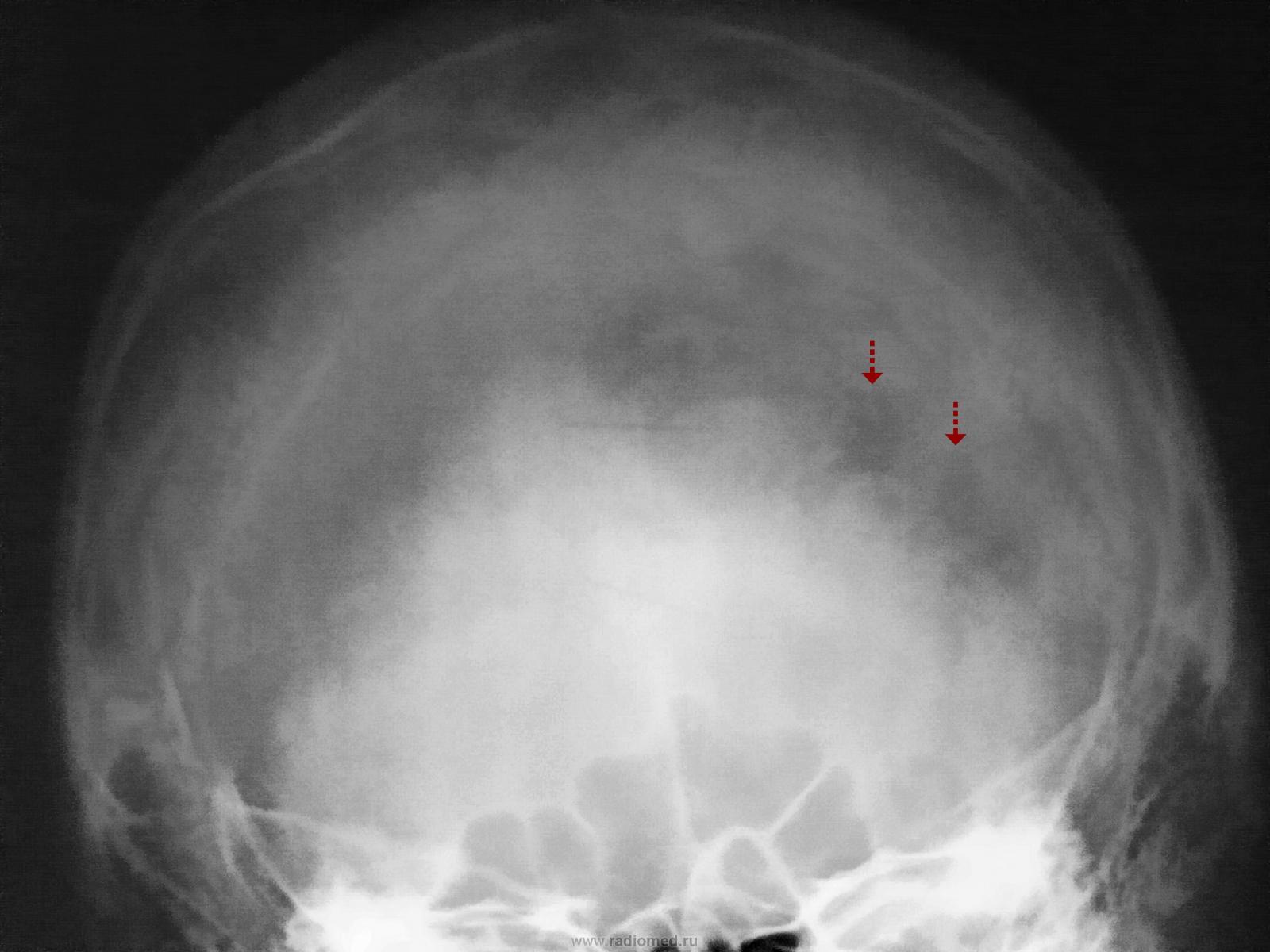 Киста в лобной доле. Пахионовы грануляции рентген черепа. Пахионовы грануляции на кт черепа. Пахионовы грануляции в затылочной кости на кт.