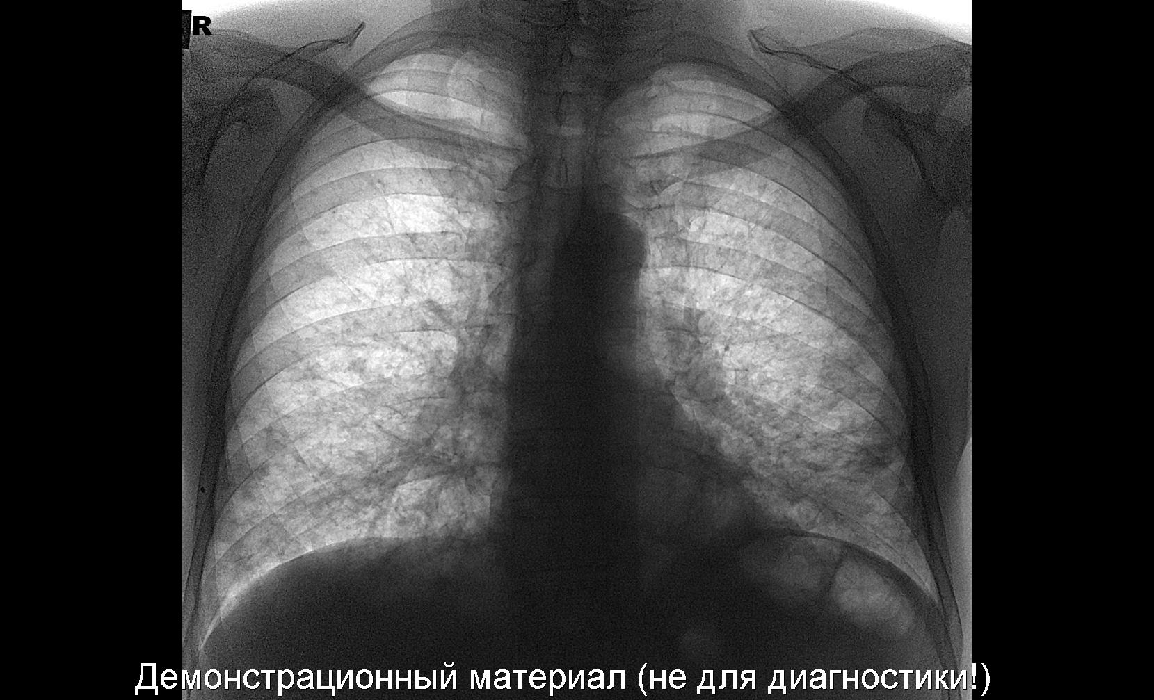 ТБС | Портал радиологов