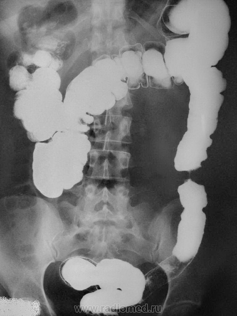 Ирригоскопия кишечника что это. Ирригоскопия Толстого кишечника рентген. Кишечная непроходимость ирригоскопия. Рентген толстой кишки ирригография. Рентгенологическое исследование Толстого кишечника (ирригоскопия)..
