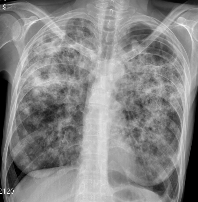 Туберкулез легкого рентгенограмма. Кавернозный туберкулез рентген. Кавернозный туберкулёз ФЛГ. Рентген снимок фиброзно кавернозный туберкулез. Туберкулез рентген снимки.