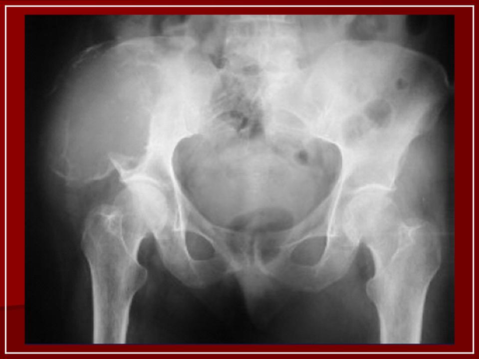 Метастатическое поражение костей. Миеломная болезнь рентген костей таза. Миеломная болезнь кости таза рентген. Миклома бедренной кости Ре. Миеломная болезнь бедренной кости.
