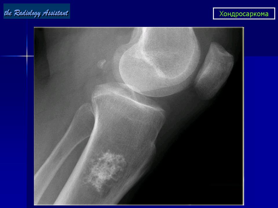 Энхондрома. Энхондрома плечевой кости рентген. Энхондрома и хондросаркома. Хондросаркома бедренной кости рентген.
