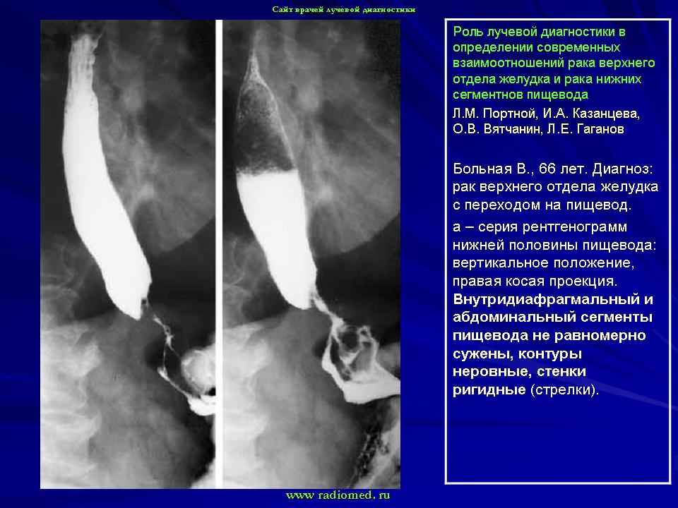 Рентгенологическая картина рака пищевода экзофитный эндофитный