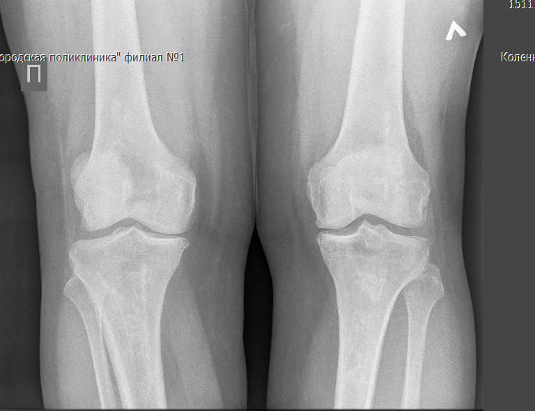 Инфаркт костного мозга коленного