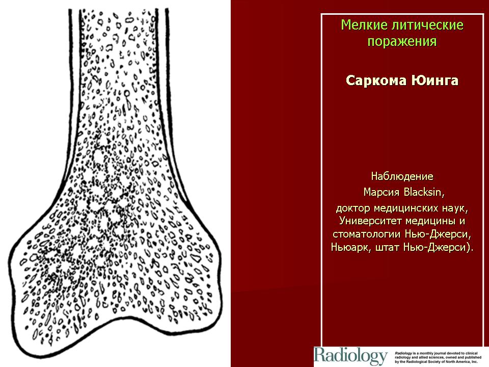 Саркома юинга презентация