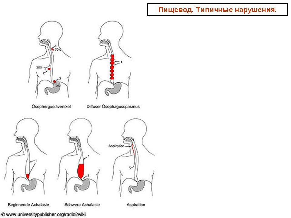 Больной пищевод