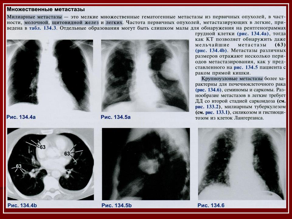 Рак молочной железы метастазы в легких. Метастазы в лёгких рентген заключение. Кт легких снимки с описанием. Метастазы на снимках кт.