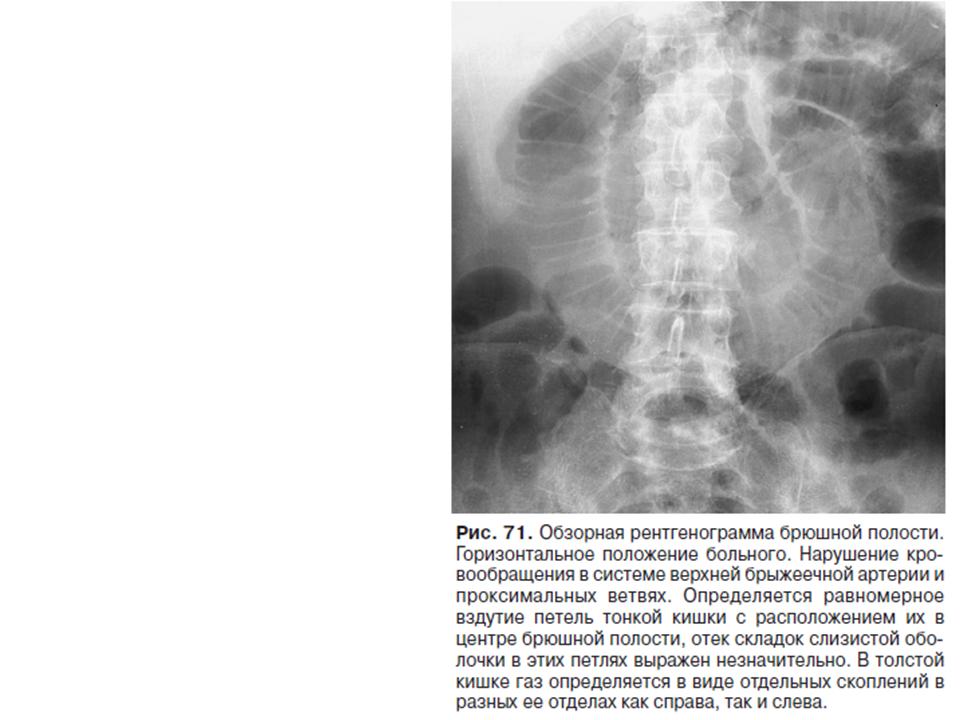 Расширение петель кишечника. Раздутые петли Толстого кишечника рентген. Обзорный снимок брюшной полости рентген. Петли кишечника на рентгене. Расширенные петли кишечника.