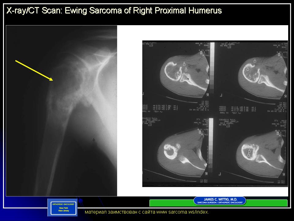 Саркома юинга у детей. Саркома Юинга мягких тканей. Саркома Юинга плечевой кости рентген. Саркома Юинга малой берцовой кости.