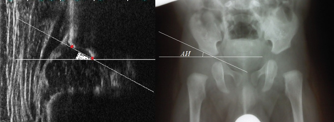 Сонография тазобедренных суставов новорожденных - Граф Рейнгард