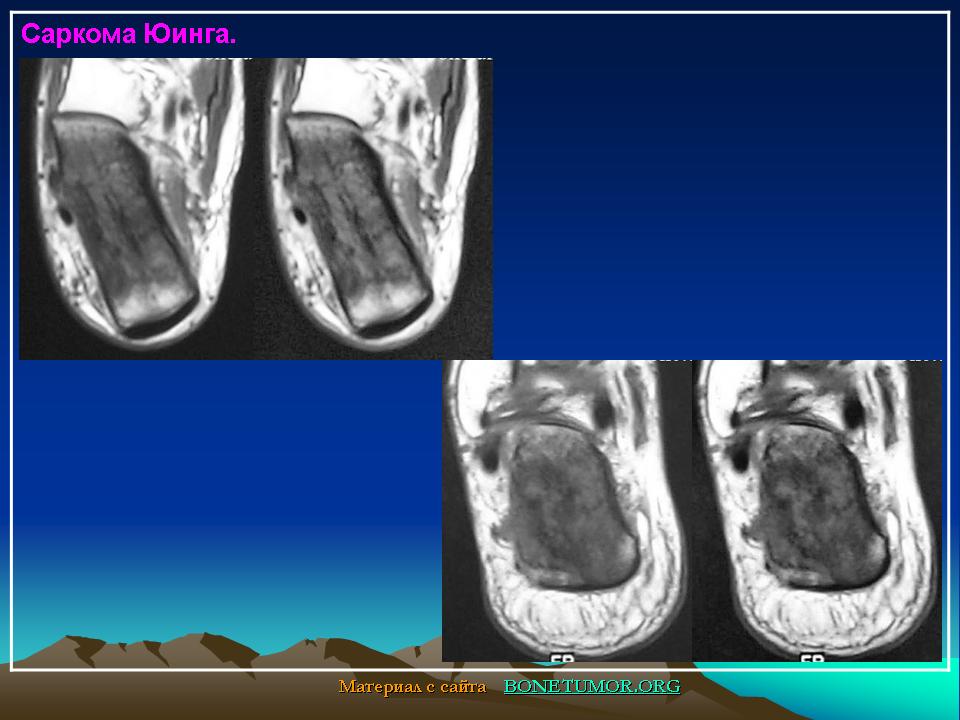 Саркома юинга презентация