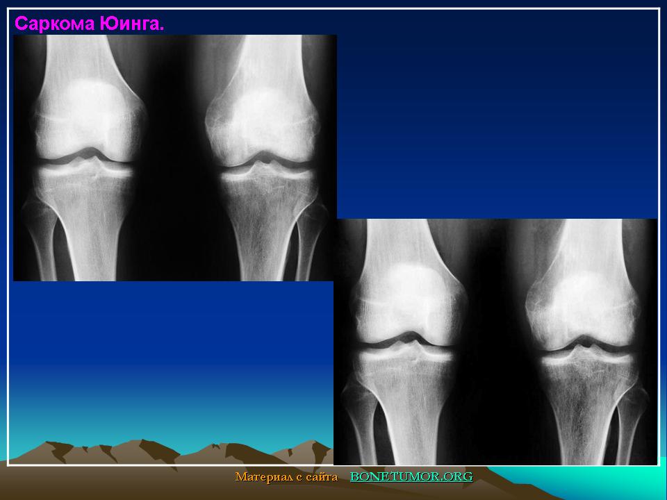 Чем отличается саркома. Внескелетная саркома Юинга. Саркома Юинга коленного сустава.