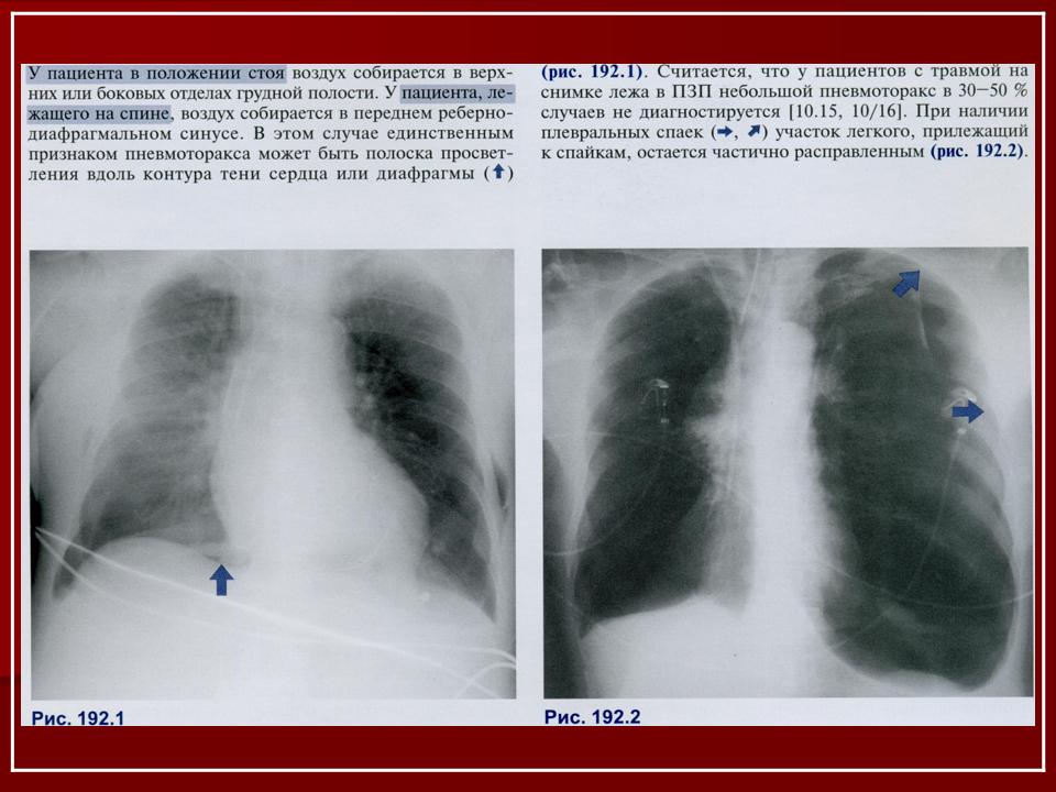 Пневмоторакс лучевая диагностика презентация