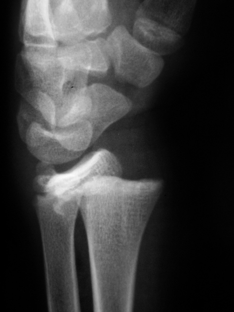 Эпифизеолиз. Остеоэпифизеолиз лучевой кости рентген. Эпифизеолиз лучевой кости у ребенка. Эпифизеолиз локтевой кости рентген.