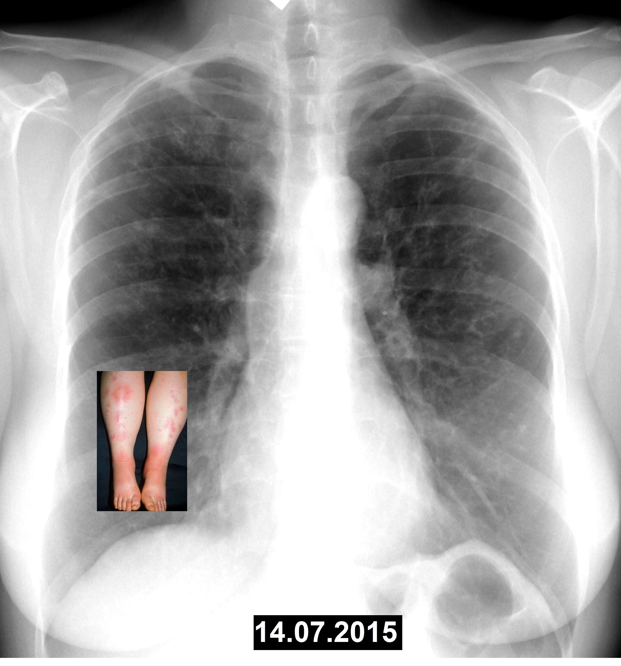 1 легкое меньше другого. Снимок двухсторонней пневмонии. Двухсторонняя пневмония рентген. Двухстороннее воспаление лёгких. Рентген легких пневмония двухсторонняя.