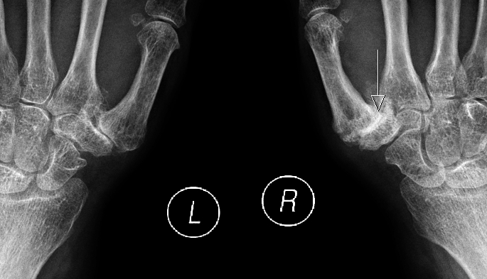 Рентген подвивихов 1 пястной кости кисти. Перелом трапециевидной кости запястья рентген. Пястно трапециевидный сустав рентген.
