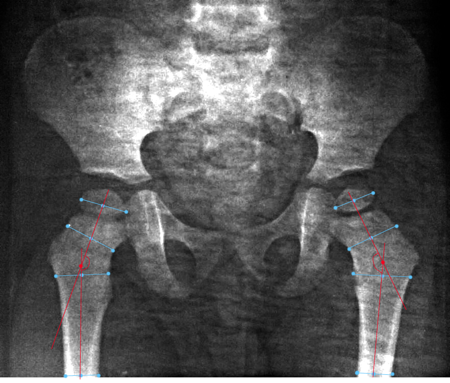 Что такое тбс. Подвывих тазобедренного сустава рентген. Вывих тазобедренного сустава рентген.