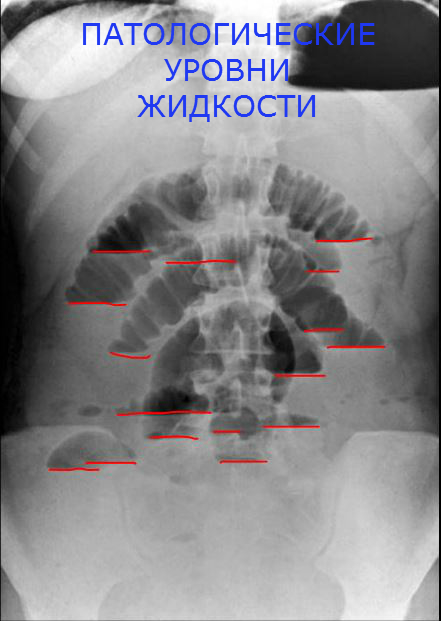 Кишечная непроходимость рентген. Чаши Клойбера на рентгенограмме. Рентген при кишечной непроходимости.