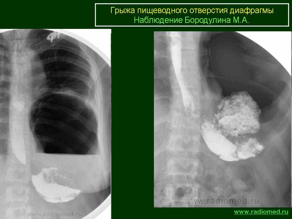 Грыжа пищеводного отверстия диафрагмы